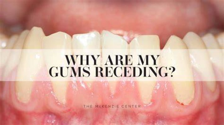 Why is my gum receding around my implant?