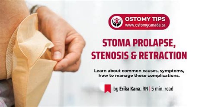 Why is my stoma so active at night?