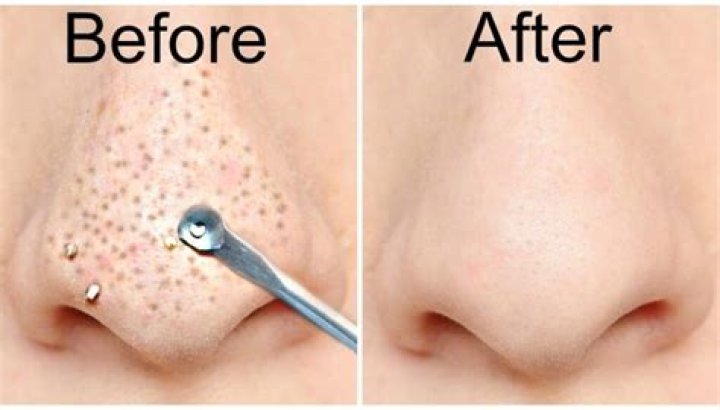 Why is removing blackheads so satisfying?