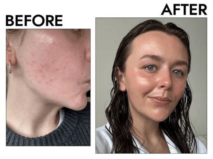 Why is tretinoin not working for my acne?
