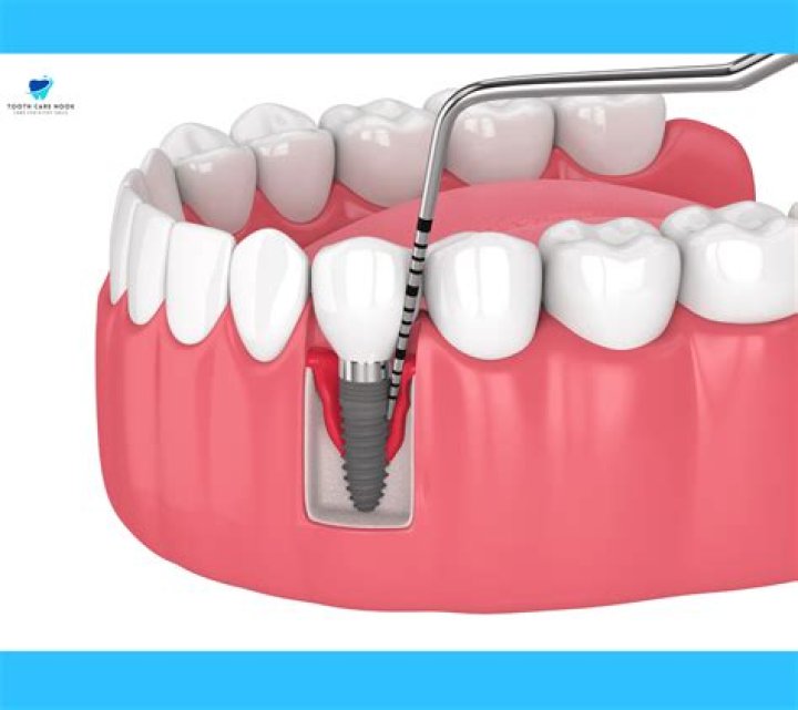 Why would a dental implant need to be removed?