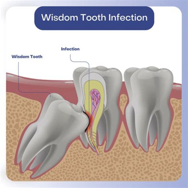 Will a tooth abscess drain on its own?