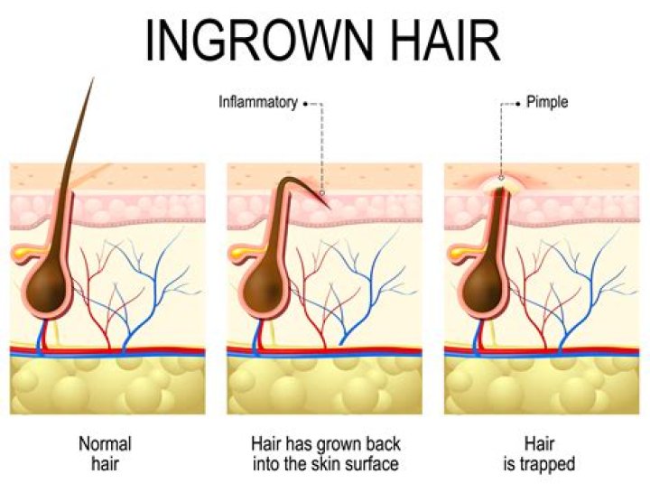 Will ingrown hairs go away on their own?