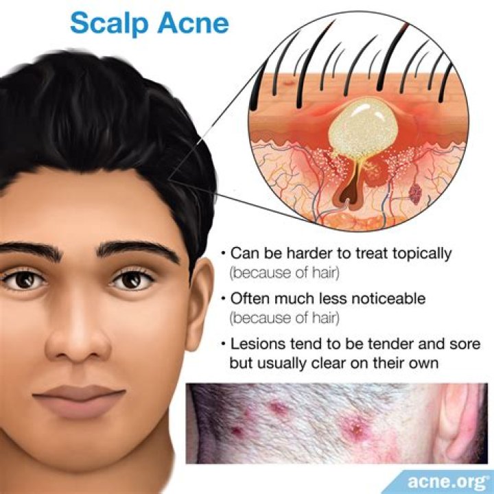 Will IUD help with acne?