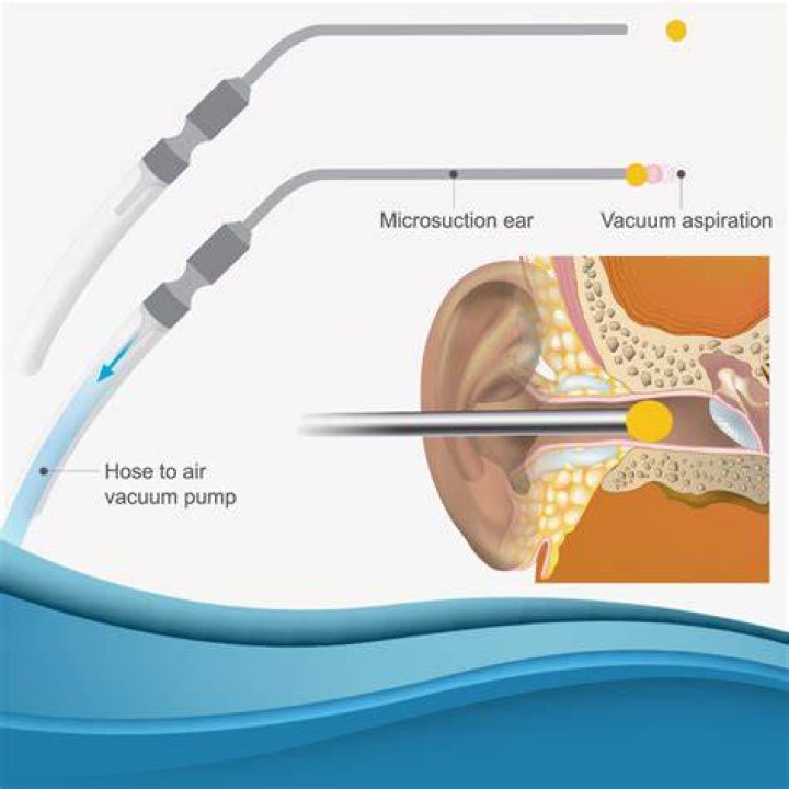 Will Microsuction unblock my ear?