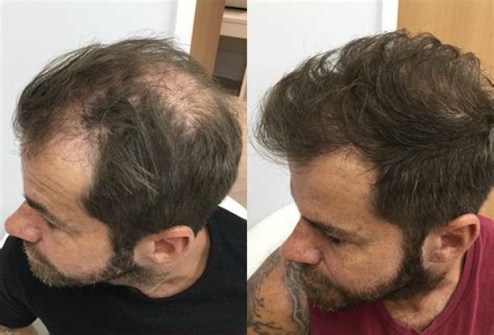 Will my hair grow back after quitting vaping?