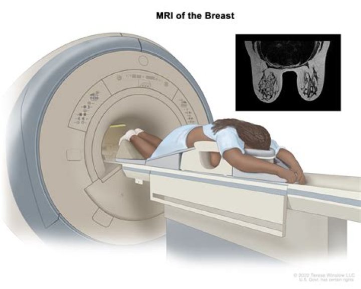 Will Parkinsons show up on an MRI?