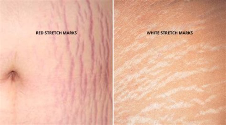 Will red stretch marks turn white?