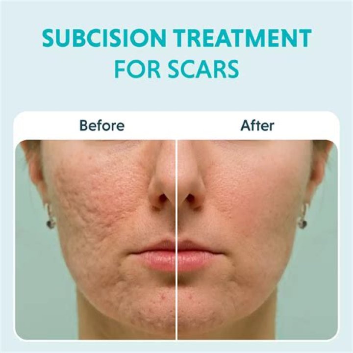 Will teenage acne scars fade?