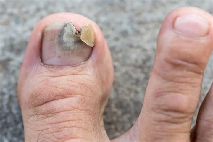 Will toenail fungus ever go away?